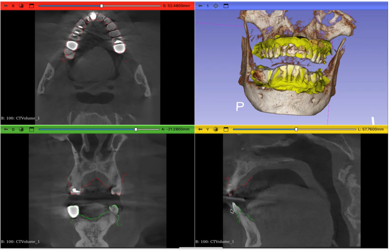 Segmentation 3D des mâchoires et recalage d'empreintes intraorales sur un volume CBCT